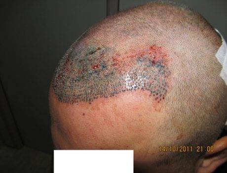 Trapianto Capelli FUE – 29 Anni – 1500 Innesti – 1 Sessione