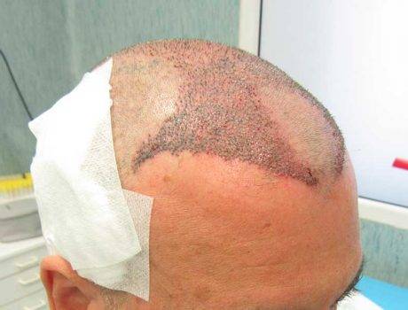 Trapianto Capelli FUE – 53 Anni – 2800 Innesti – 1 Sessione