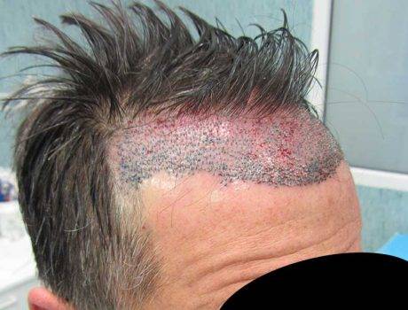 Trapianto Capelli FUE – 52 Anni – 1500 Innesti – 1 Sessione