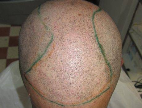 Trapianto Capelli FUE – 32 Anni – 2590 Innesti – 1 Sessione