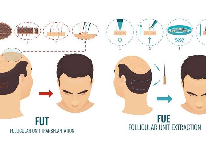 FUE e FUT: differenze ed aspetti comuni