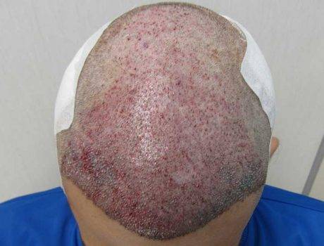 Trapianto Capelli Fue – 26 Anni – 3000 Innesti – 1 sessione